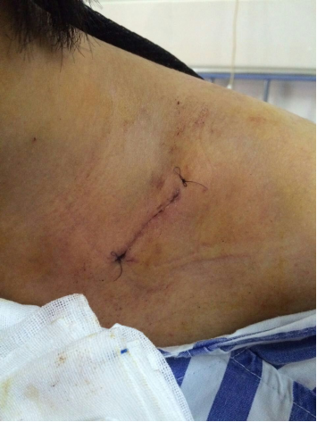 锁骨骨折手术疤痕图片图片